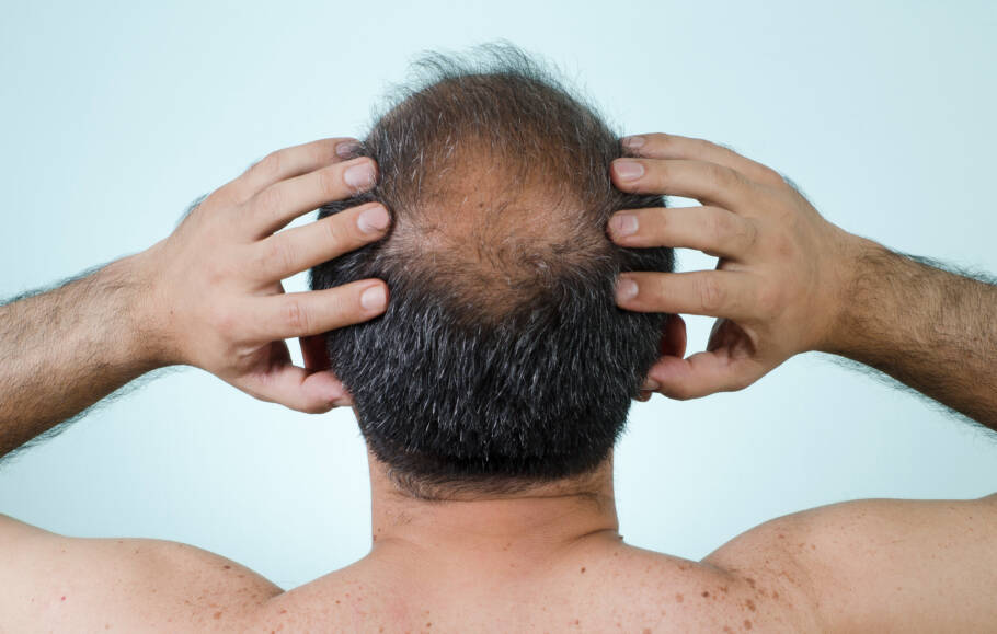 Um remédio herbal milenar está demonstrando um potencial surpreendente contra a queda de cabelo