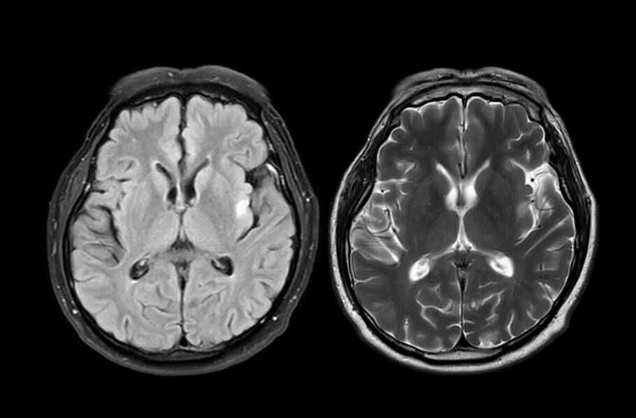 tratamento alzheimer