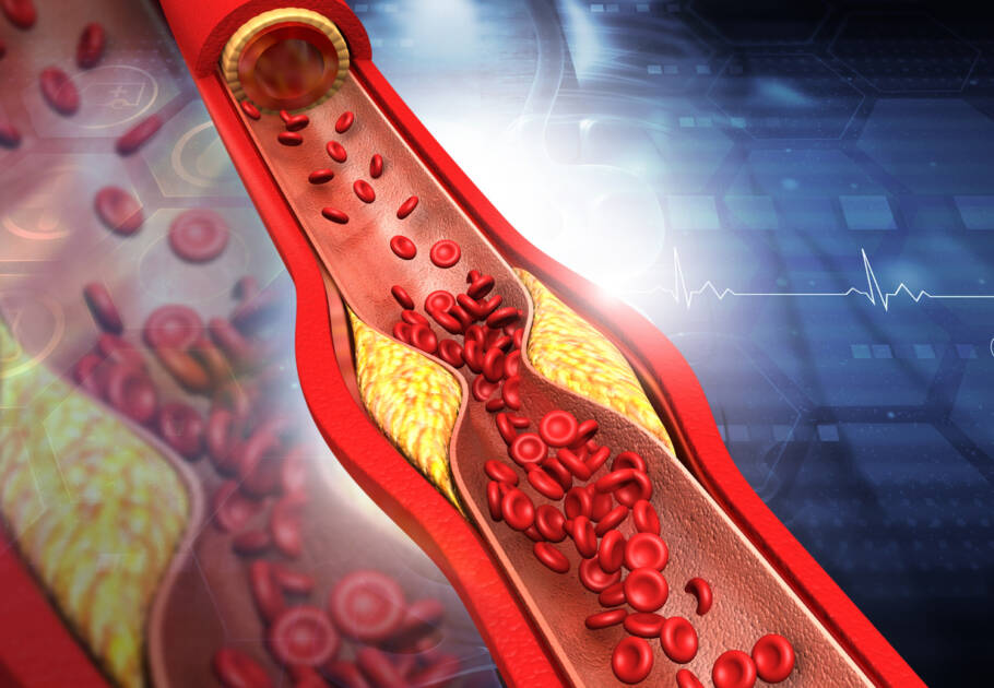 Novo exame de colesterol pode prever melhor o risco de infarto e AVC, aponta estudo Exame que investiga partículas de colesterol no sangue se mostra mais eficaz na prevenção de doenças cardíacas do que teste convencional